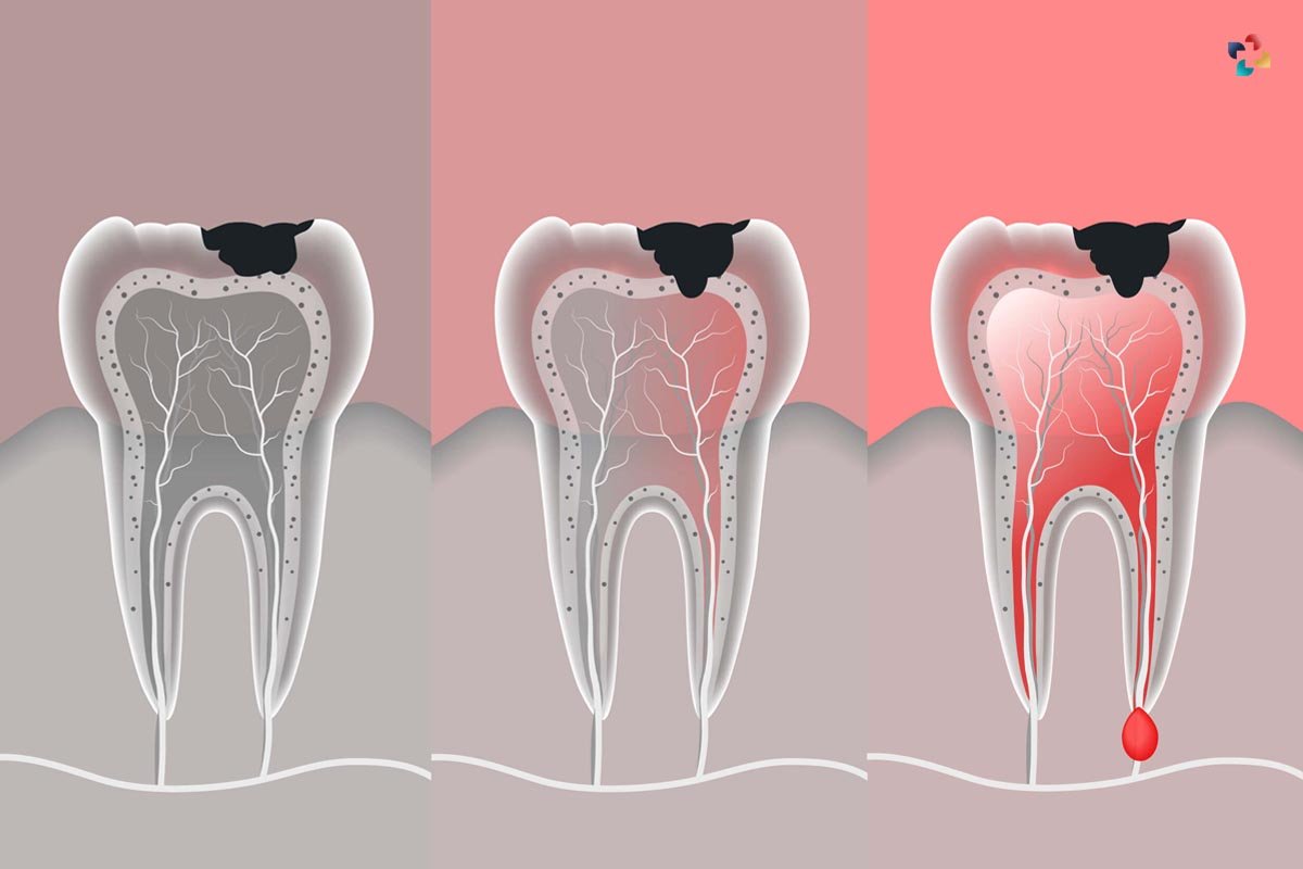 11 Basic Causes of Tooth Pain and What to Do About It | The Lifesciences Magazine