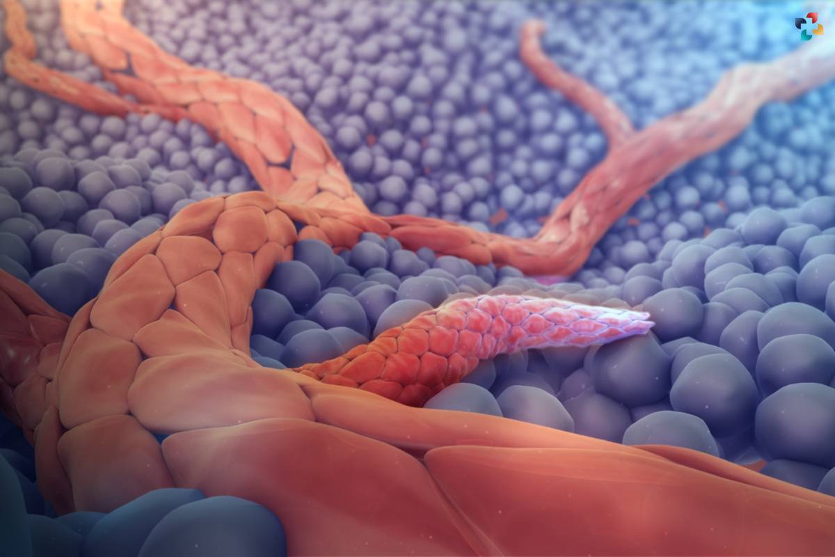 Angiogenesis: Meaning and Relation with cancer | The Lifesciences Magazine