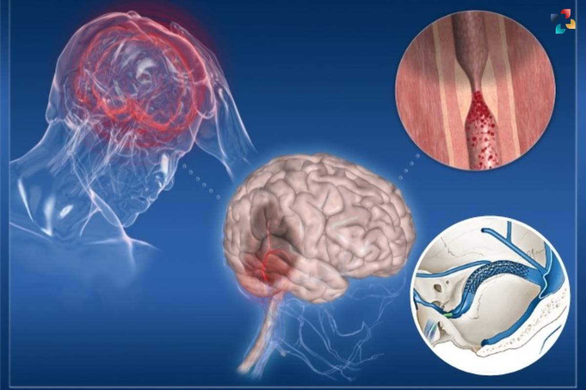 Explore Pseudotumor Cerebri: Causes, Symptoms, and Treatment Options | The Lifesciences Magazine