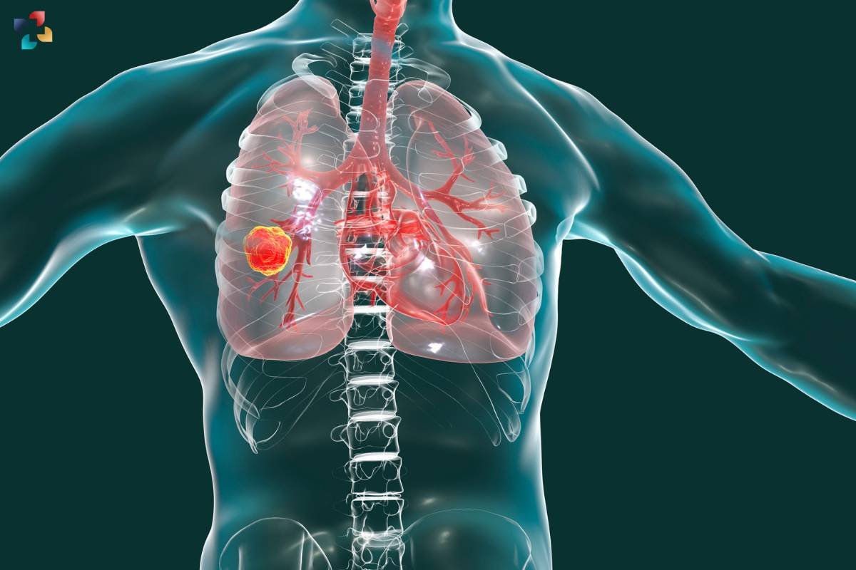 Lung Cancer Surgery: Types, Procedures, and Recovery | The Lifesciences Magazine