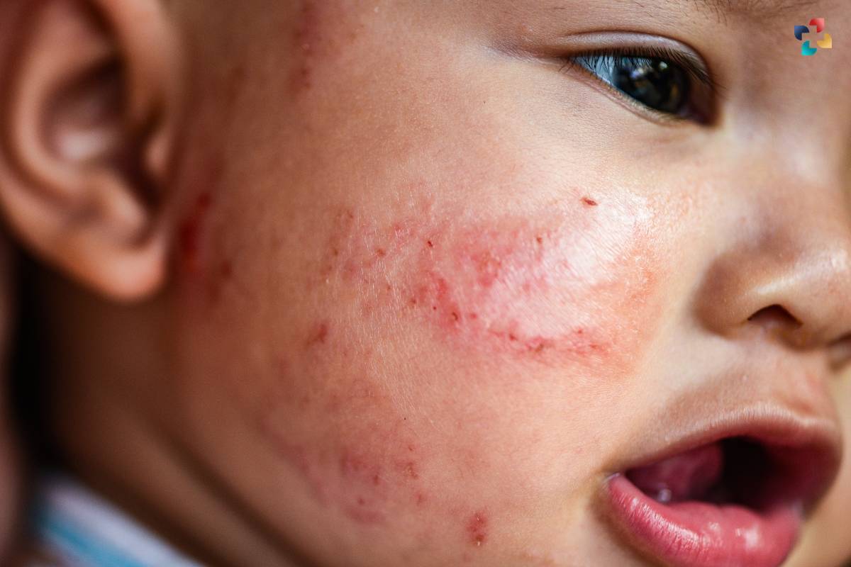 Understanding Eczema on Face: Causes, Symptoms, and Treatment Options