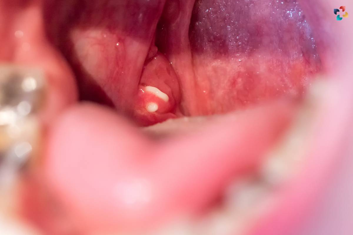 Understanding Tonsil Stones: Causes, Symptoms, and Treatment Options