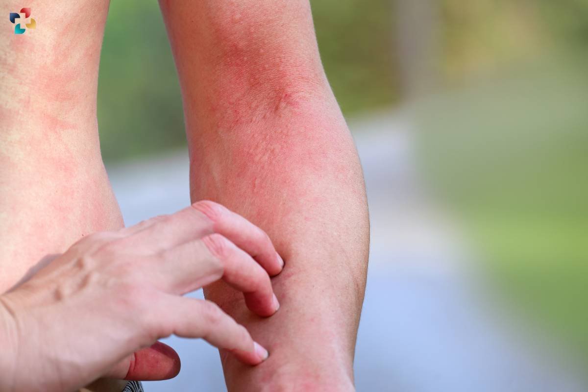 Red spots on the skin: Causes, Symptoms, and Treatment Options | The Lifesciences Magazine