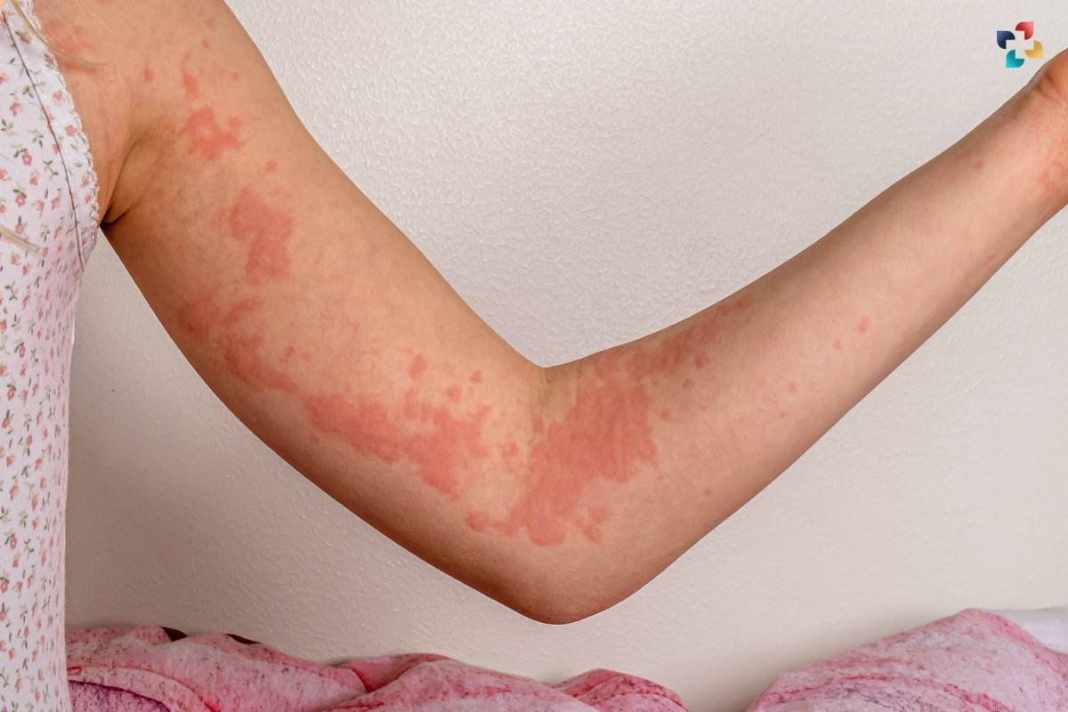 Pressure Urticaria: Important Causes, Symptoms, and Treatment | The Lifesciences Magazine