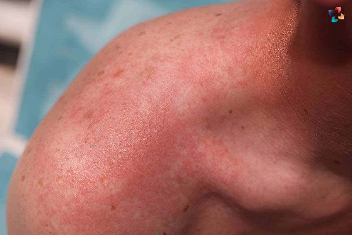 Pressure Urticaria: Important Causes, Symptoms, and Treatment | The Lifesciences Magazine