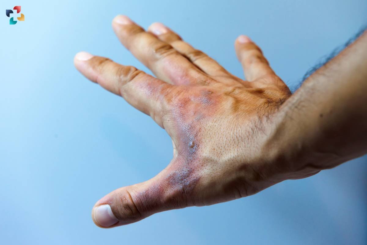 Second-Degree Burns: Causes, Symptoms, and Treatment | The Lifesciences Magazine