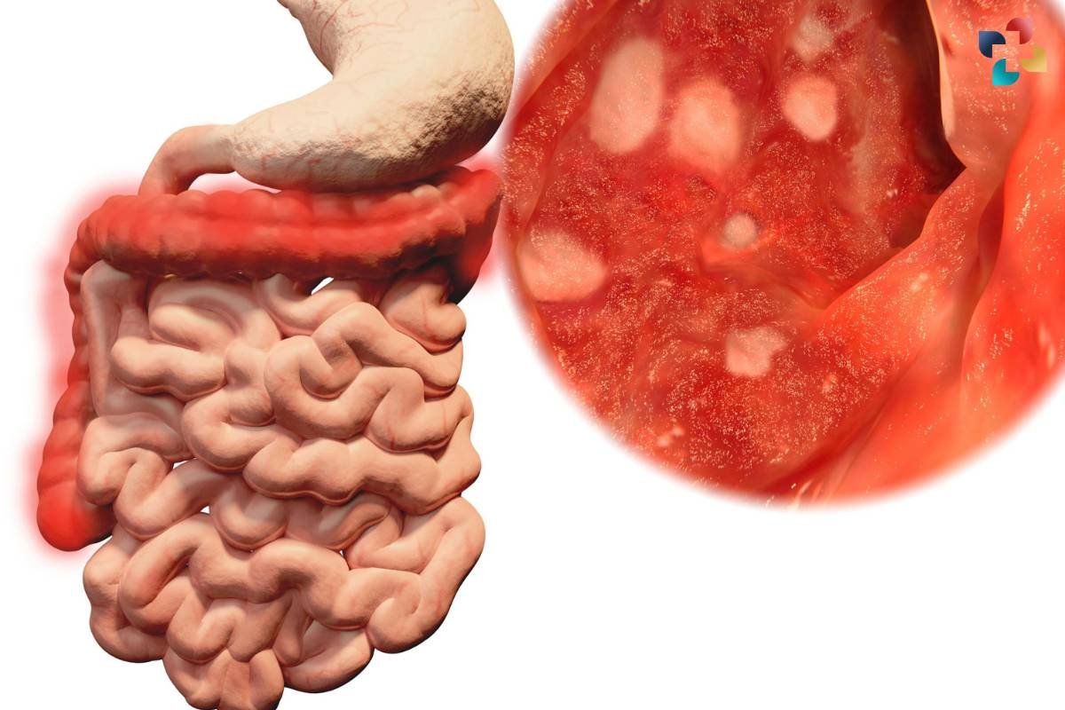 Differences Between Ulcerative Colitis vs Crohn's Disease | The Lifesciences Magazine