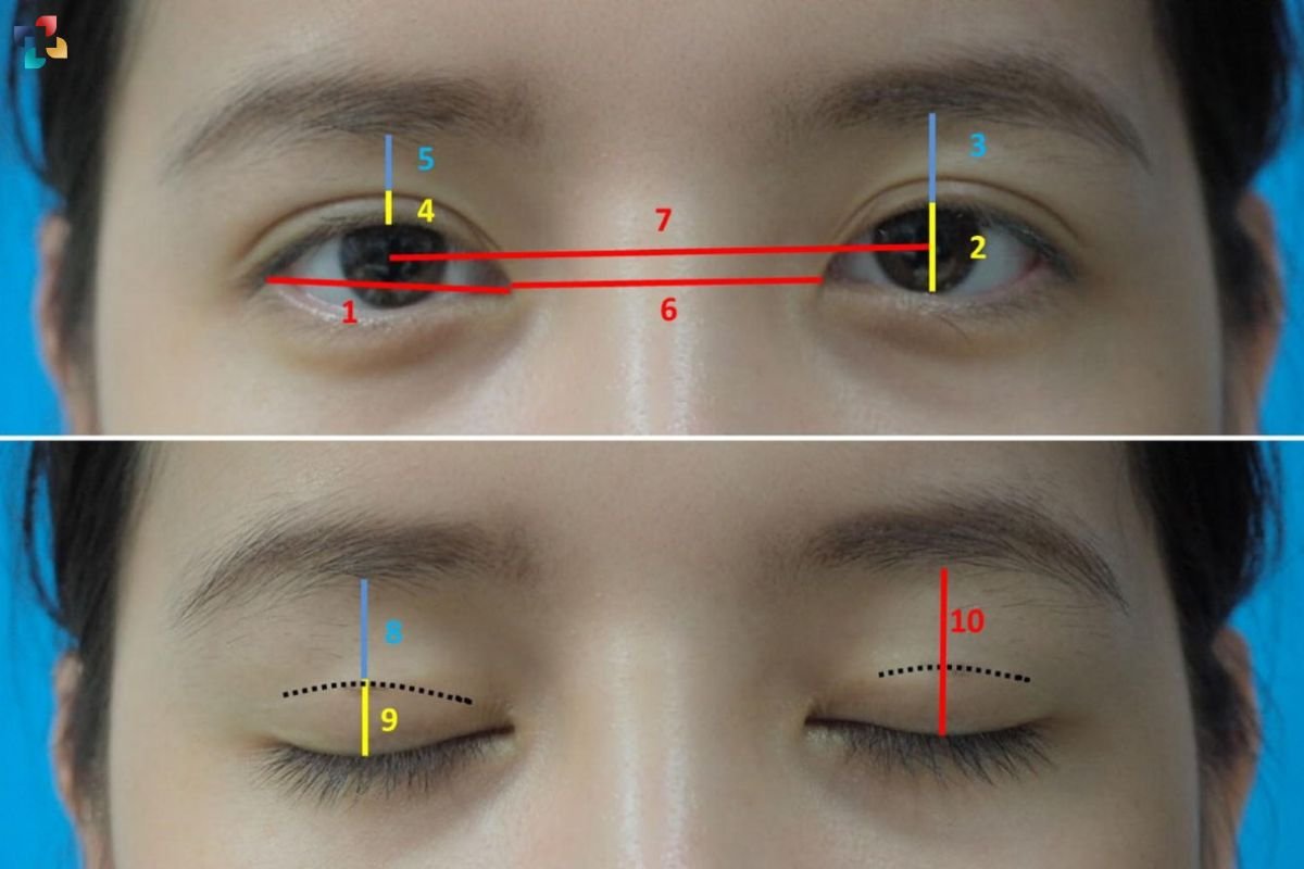 Double Eyelid Surgery: Meaning, Benefits, Risks, and Procedure | The Lifesciences Magazine