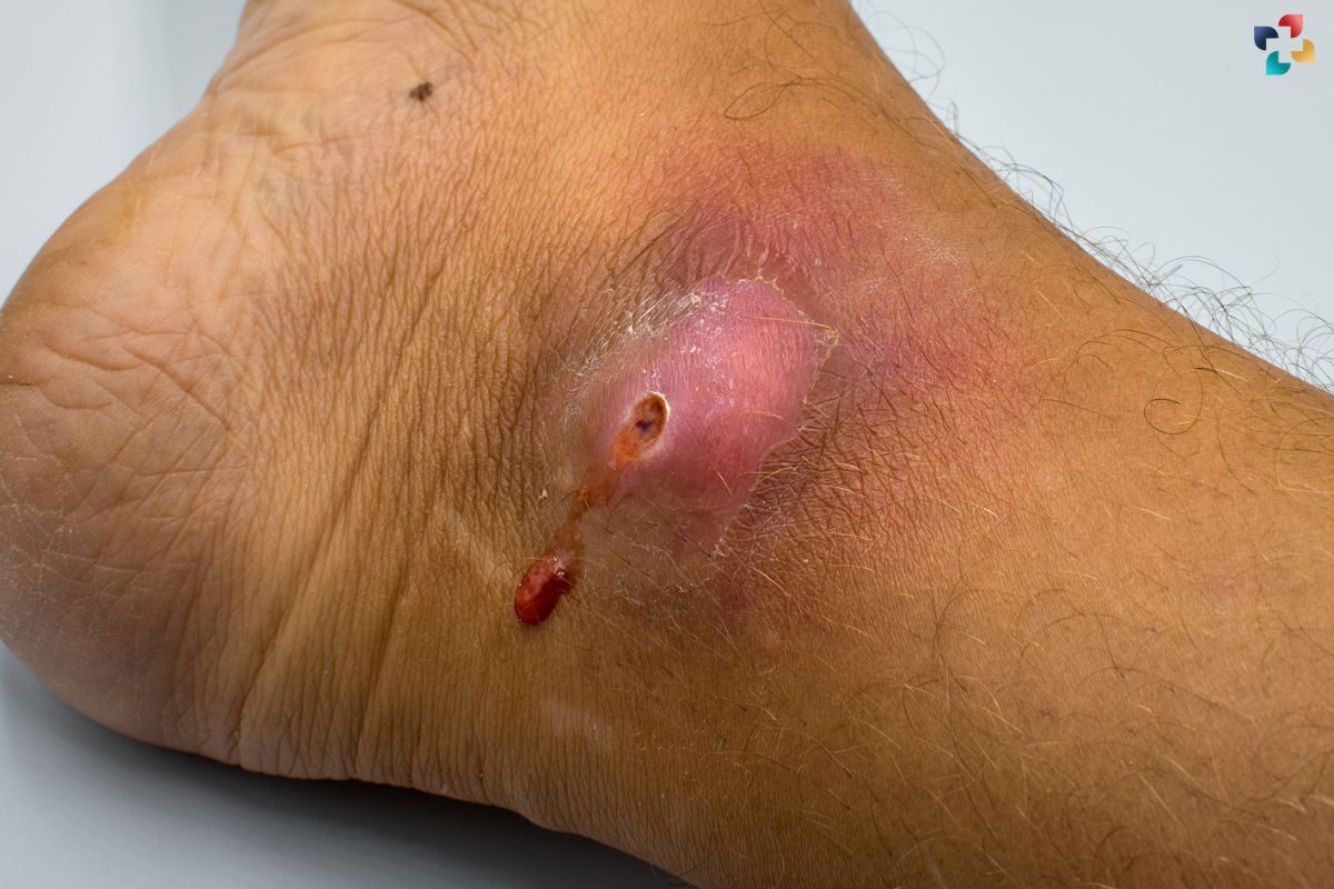 Infected Wounds: Causes, Symptoms, Treatment, and Prevention | The Lifesciences Magazine