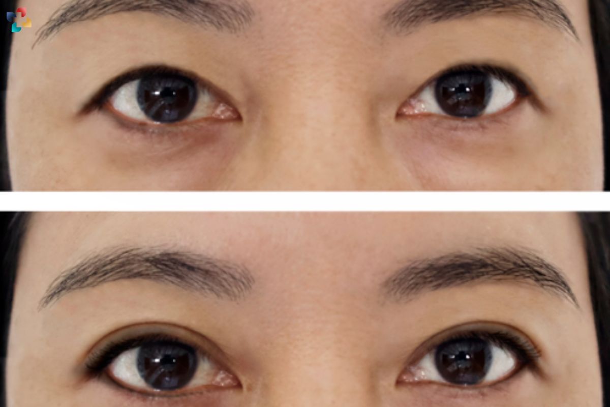 Double Eyelid Surgery: Meaning, Benefits, Risks, and Procedure | The Lifesciences Magazine