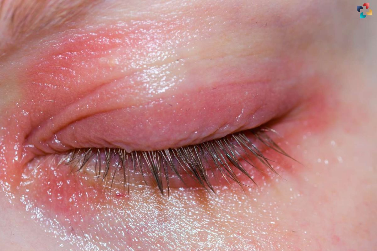 Understanding Swollen Eyelids Causes Symptoms And Best Treatment Options The Lifesciences 