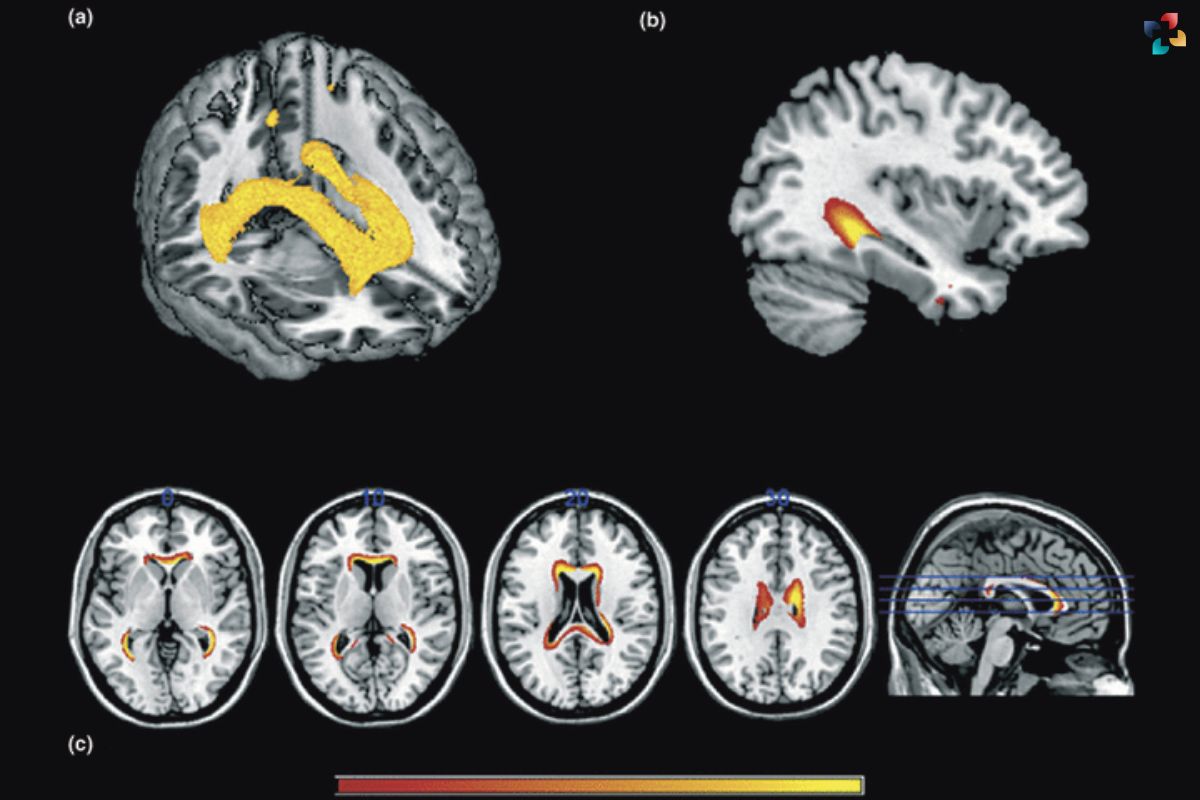 Mysteries of Posterior Cortical Atrophy: Symptoms, Causes, and Management | The Lifesciences Magazine