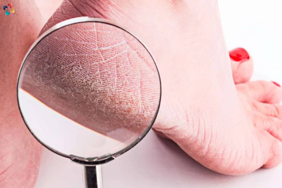 Peeling Feet: 8 Causes, Treatments, and Prevention | The Lifesciences Magazine