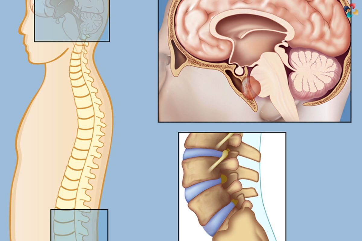 Study Identifies Genetic Causes of Pediatric Chordoma | The Lifesciences Magazine