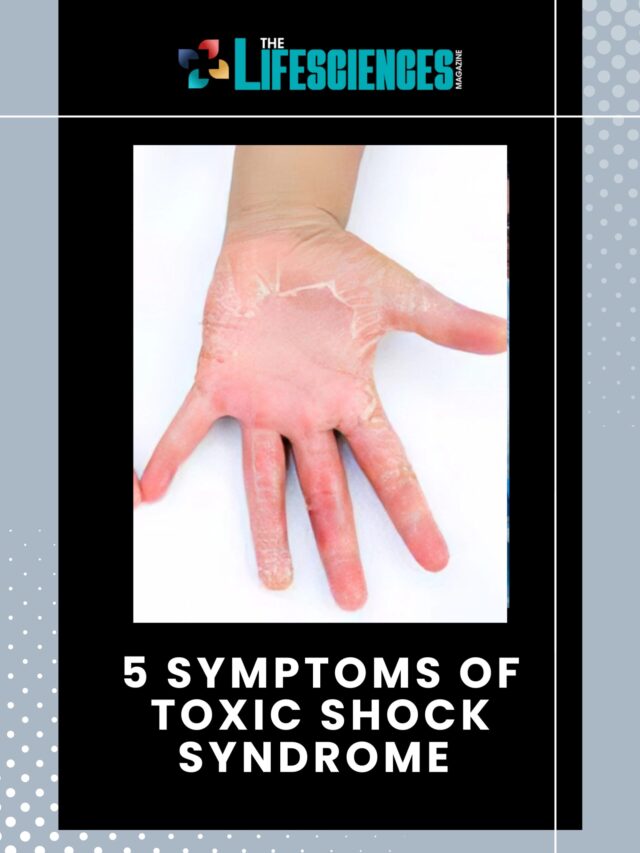 5 Symptoms of Toxic Shock Syndrome | The Lifesciences Magazine