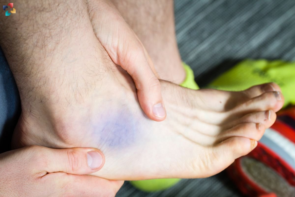 Foot Contusion: Causes, Symptoms, Treatment, and Prevention | The Lifesciences Magazine