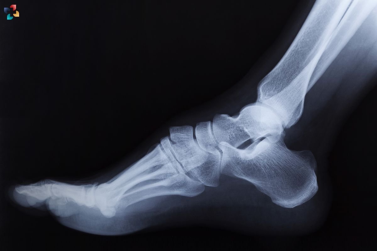 Calcaneal Stress Fracture: Causes, Symptoms & Treatment | The Lifesciences Magazine