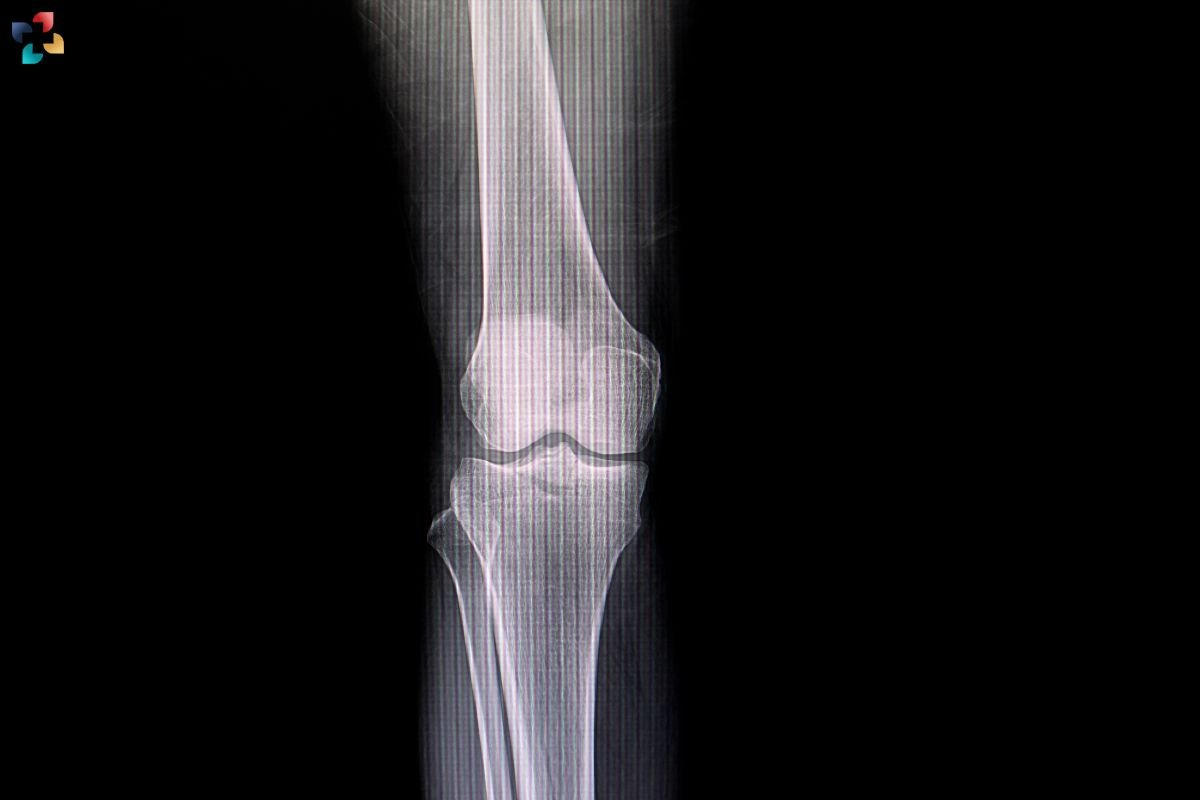 Tibial Stress Fracture (Sport Injury): Causes, Symptoms, Prevention, and Treatment | The Lifesciences Magazine