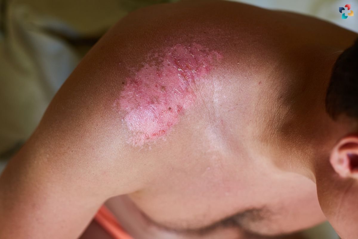 Nonmelanoma Skin Cancer: Types Causes Symptoms and Treatment | The Lifesciences Magazine