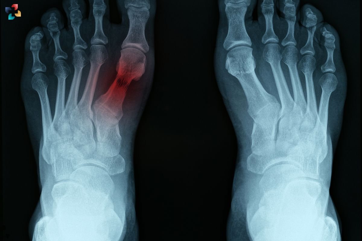 Navicular Stress Fractures: Causes, Symptoms, and Treatment | The Lifesciences Magazine