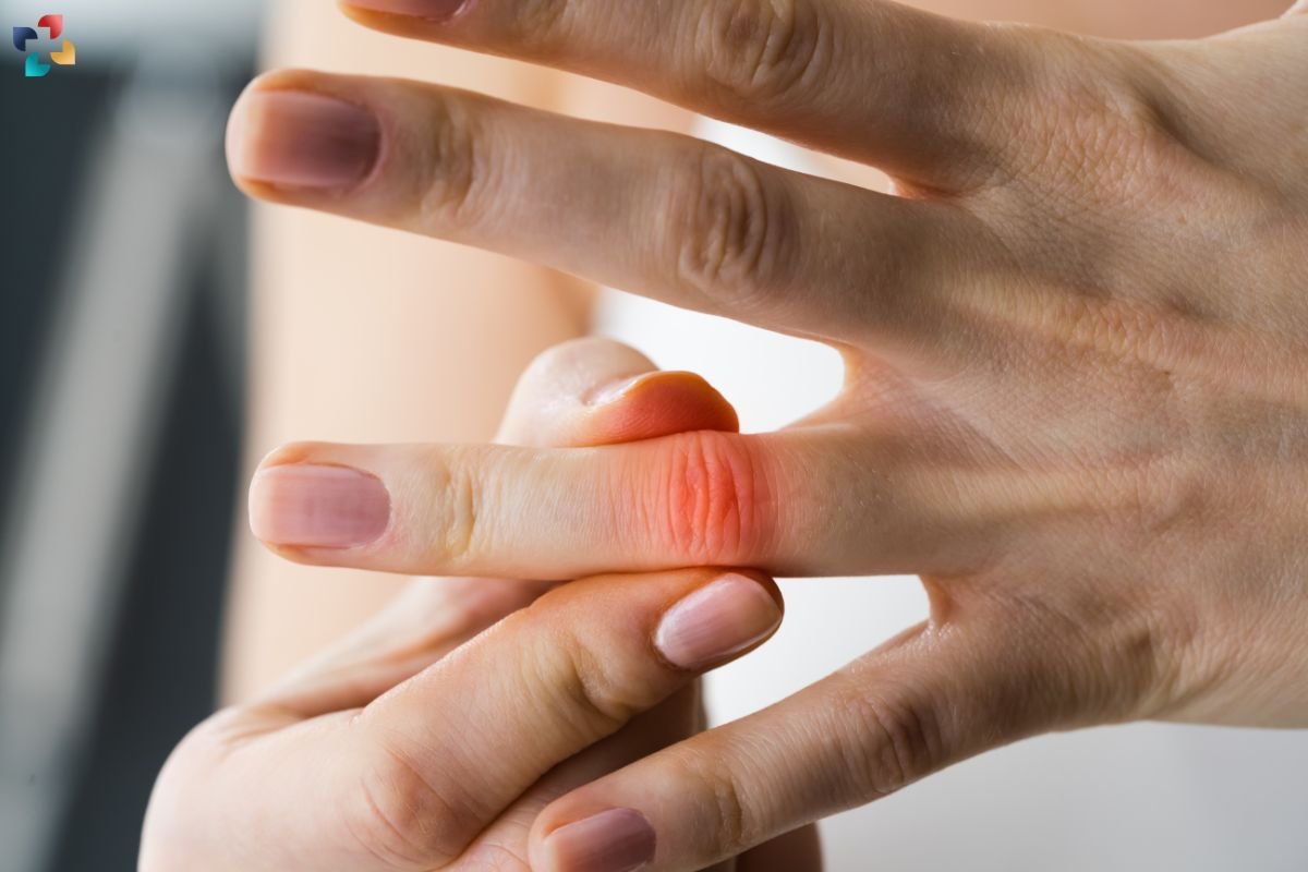 Finger Sprains: Causes, Symptoms, Diagnosis, and Treatment | The Lifesciences Magazine