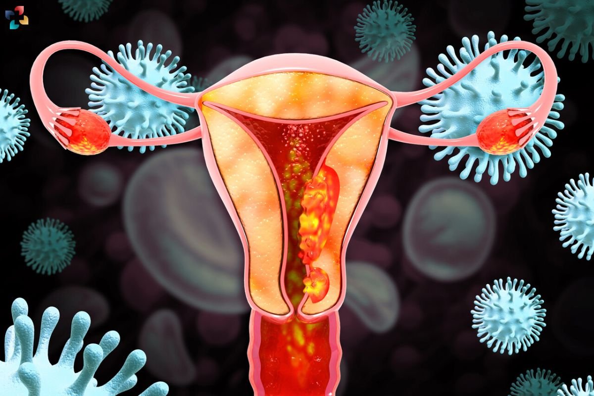 Durvalumab Gains FDA Approval for Endometrial Cancer Treatment | The Lifesciences Magazine