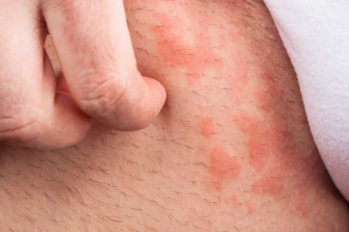 Rashes in Groin Area: Causes, Symptoms, and How to Treat Them? | The Lifesciences Magazine