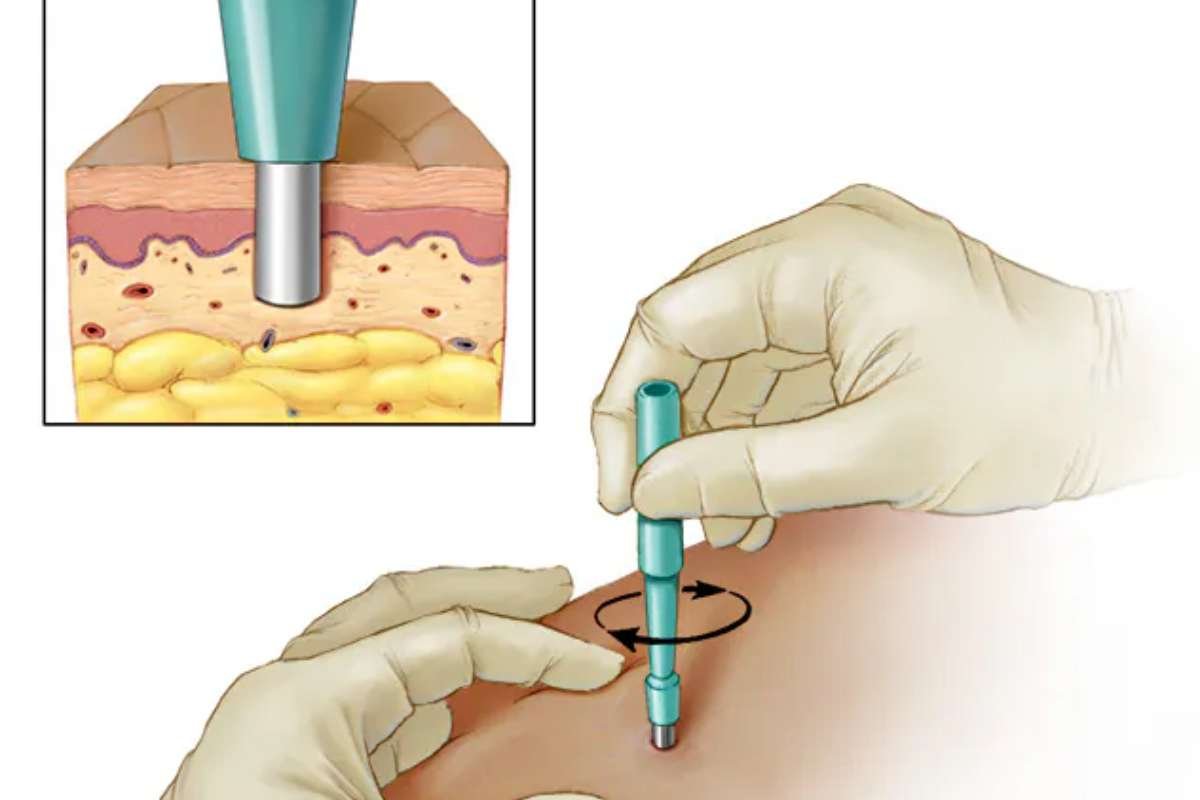 Soft Tissue Biopsy: Procedure, Types, and What to Expect? | The Lifesciences Magazine