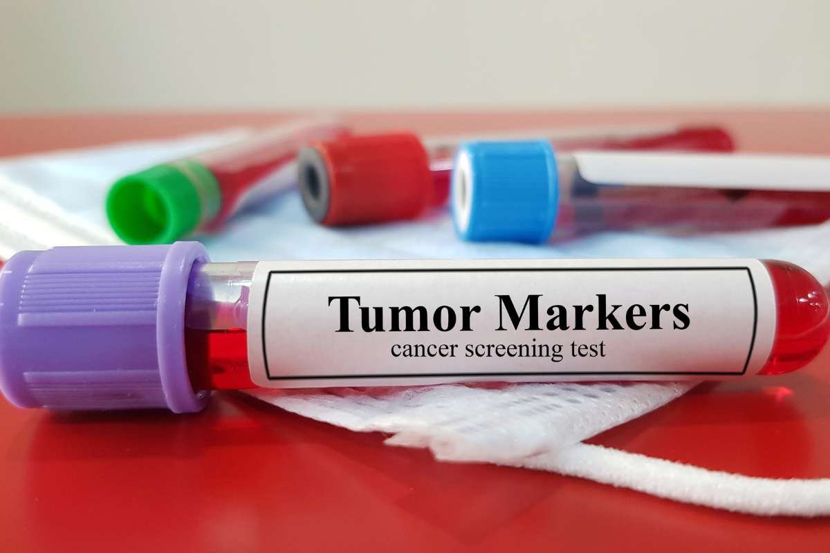 Tumor Biomarkers for Diagnosis: Understanding Their Role in Cancer Detection