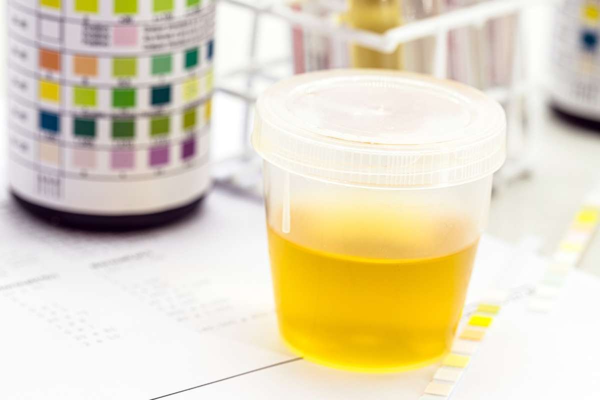 Urobilinogen in Urine: What You Should Know