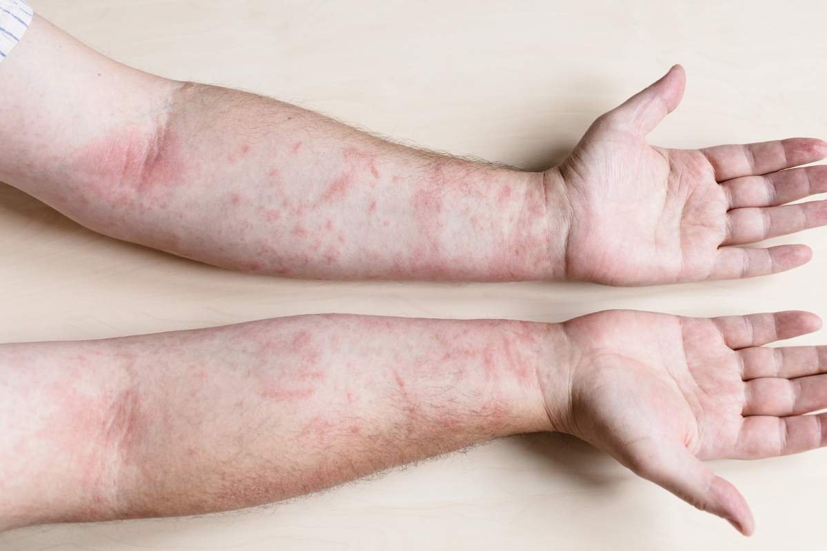 How to Treat Bacterial Skin Infections: #1 Essential Guide | The Lifesciences Magazine