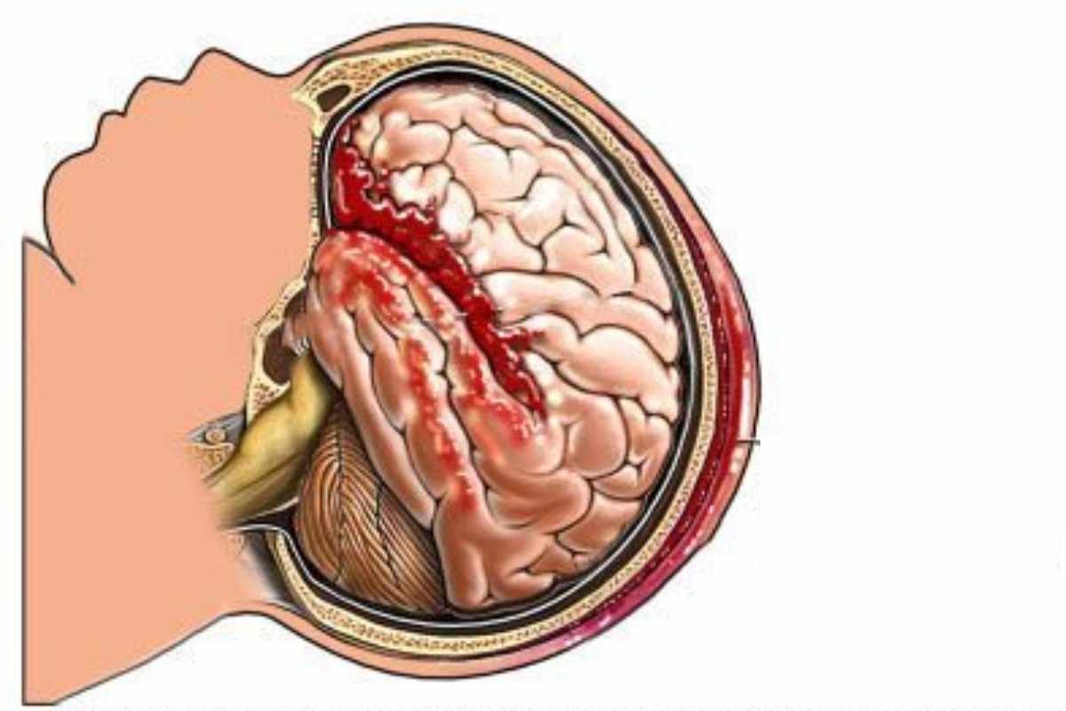 Brain Hemorrhage in Babies: Causes, Symptoms, and Treatment Options