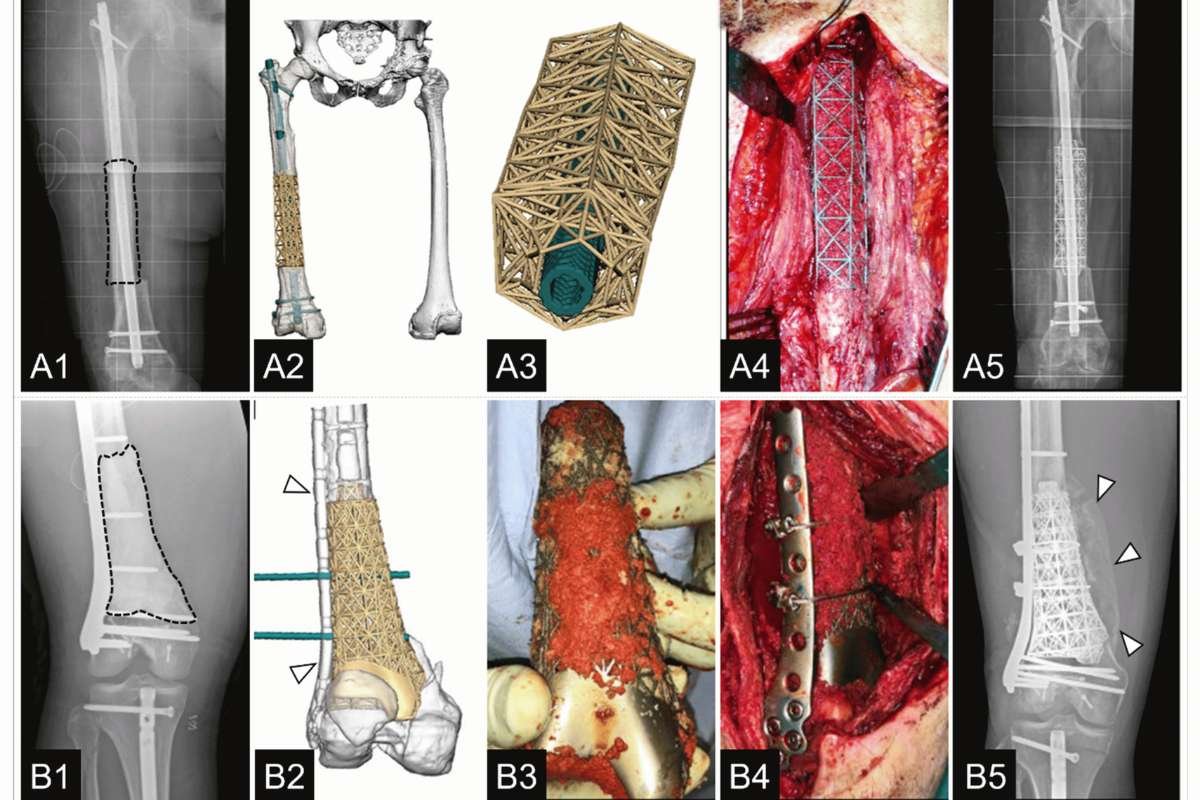 Innovative Qx-D Scaffolds: A Dual-Function Approach to Treating Infected Bone Defects