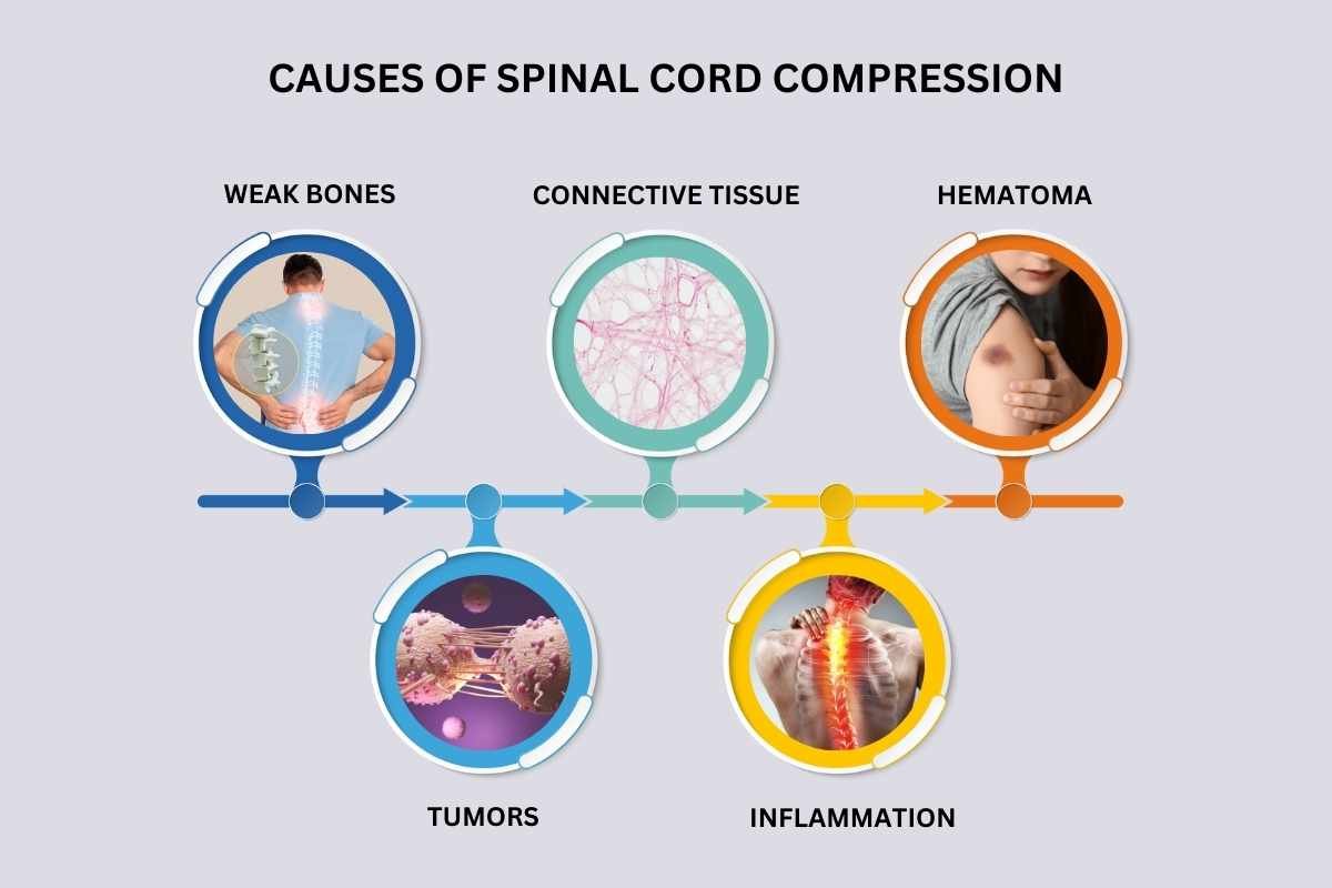 Find Symptoms of Spinal Cord Compression(What to Do Next?) | The Lifesciences Magazine