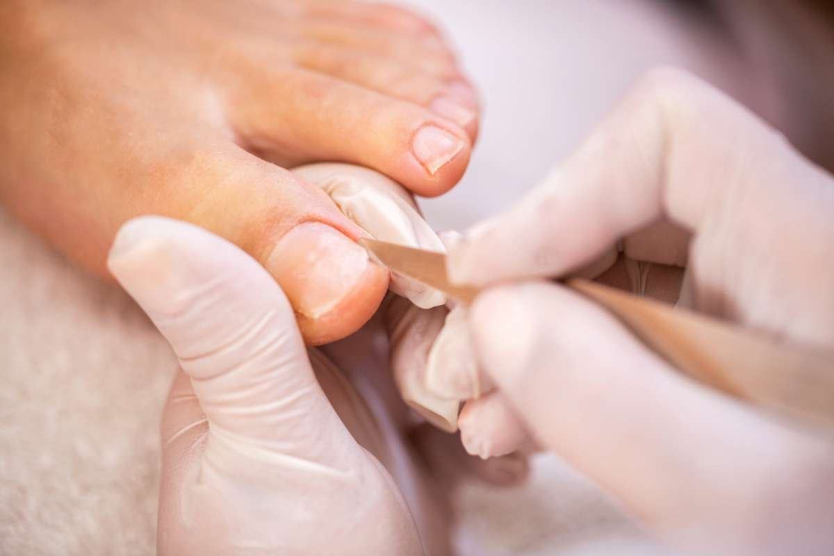 Why is My Toenail Growing at an Angle? Find Out the Fixes | The Lifesciences Magazine