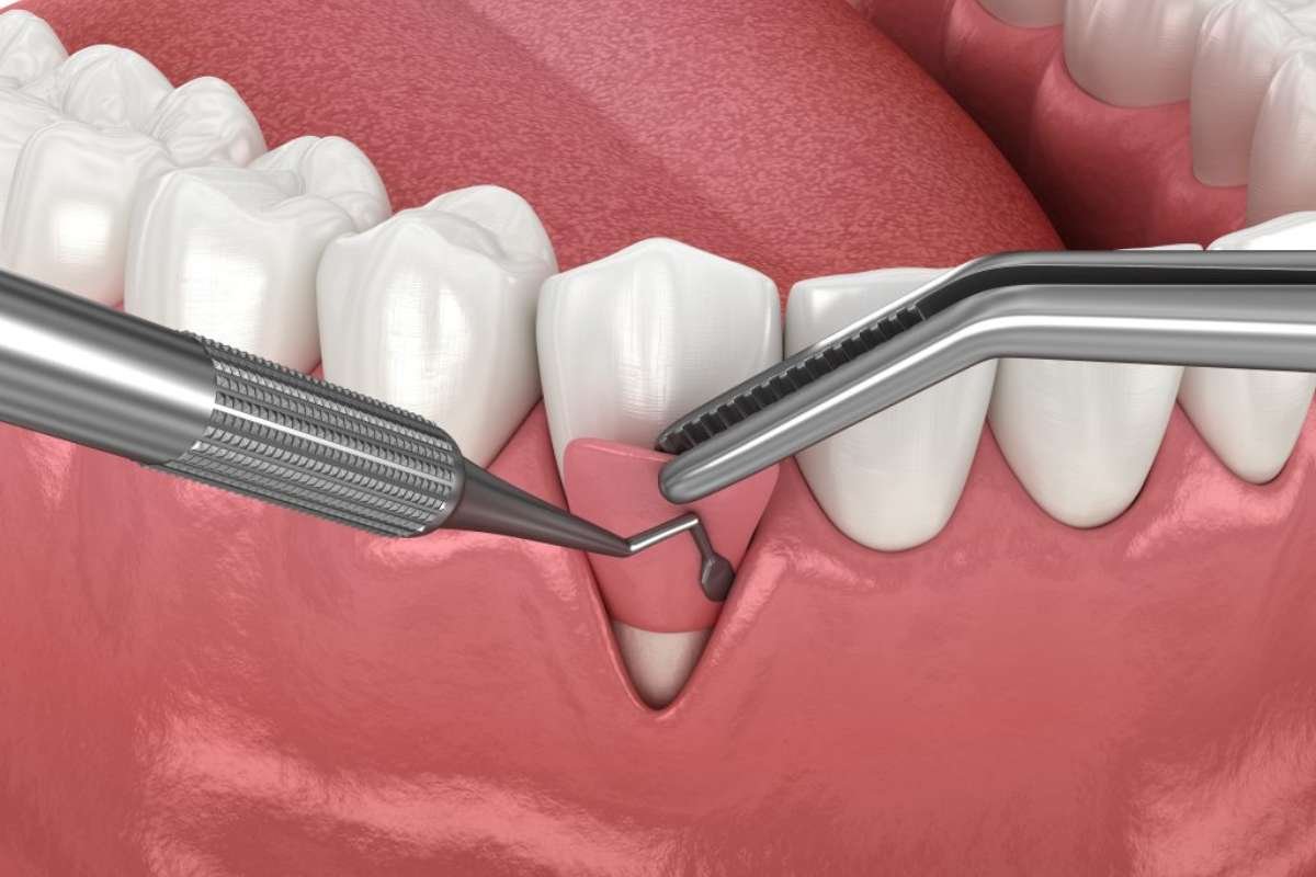 Pinhole Surgical Technique: Say Bye-Bye Gum Recession | The Lifesciences Magazine