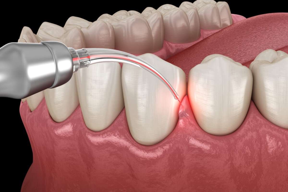 Gingivectomy 101: Important Things to Know Before Your Procedure 