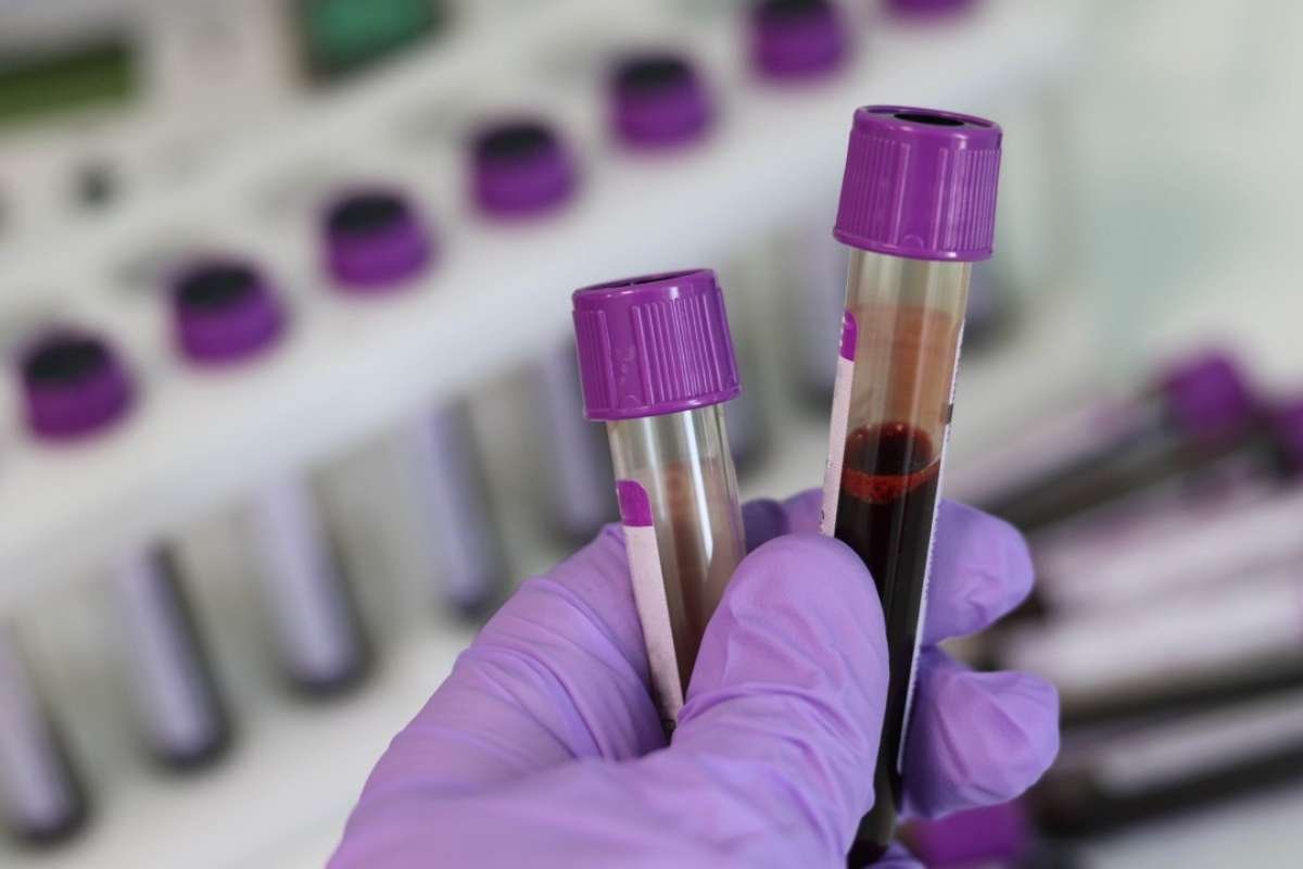 Blood Test Gives Hope for Early Pancreatic Cancer Care | The Lifesciences Magazine