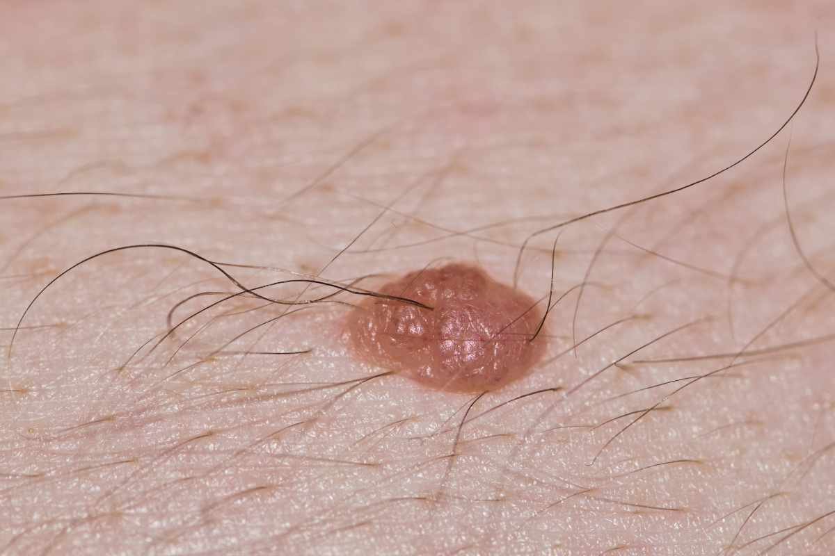 Why Does Hair Grow Out Of Moles? Surprising Answers Inside | The Lifesciences Magazine