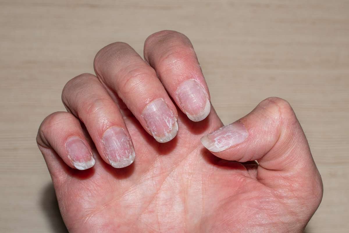Ridging in Fingernails: Causes, Types, and When to Seek Help | The Lifesciences Magazine