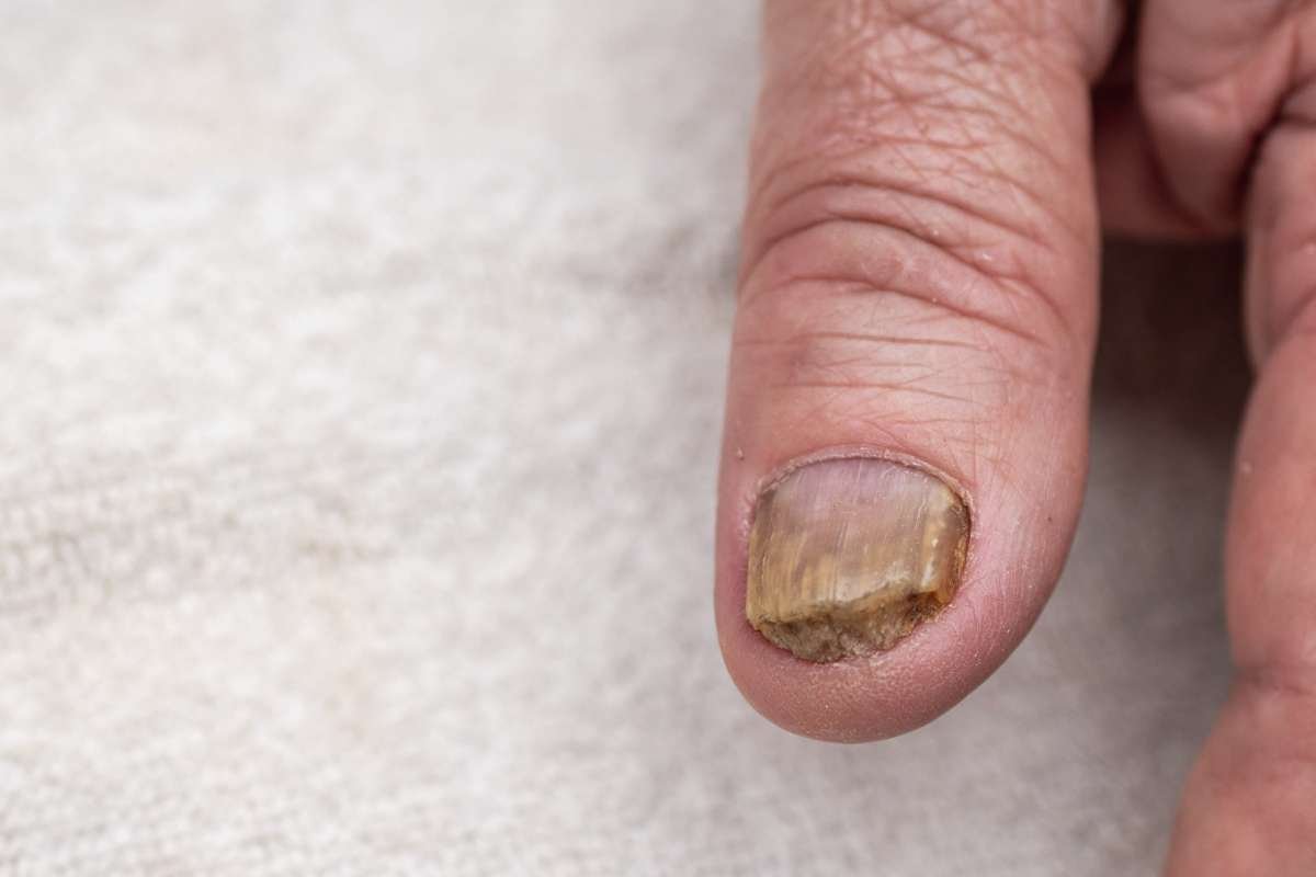 Ridging in Fingernails: Causes, Types, and When to Seek Help | The Lifesciences Magazine