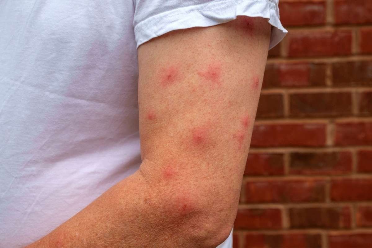 How to Identify Common Bug Bites That Could Harm Your Health? | The Lifesciences Magazine