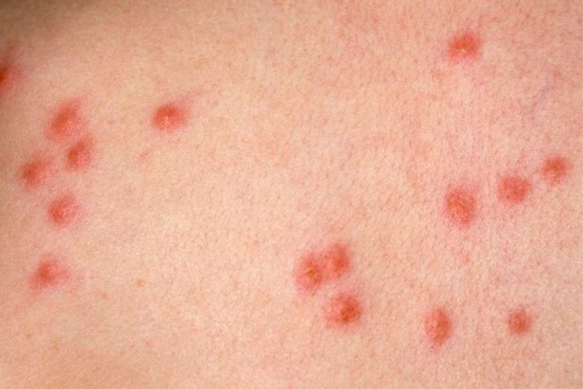 How to Identify Common Bug Bites That Could Harm Your Health? | The Lifesciences Magazine