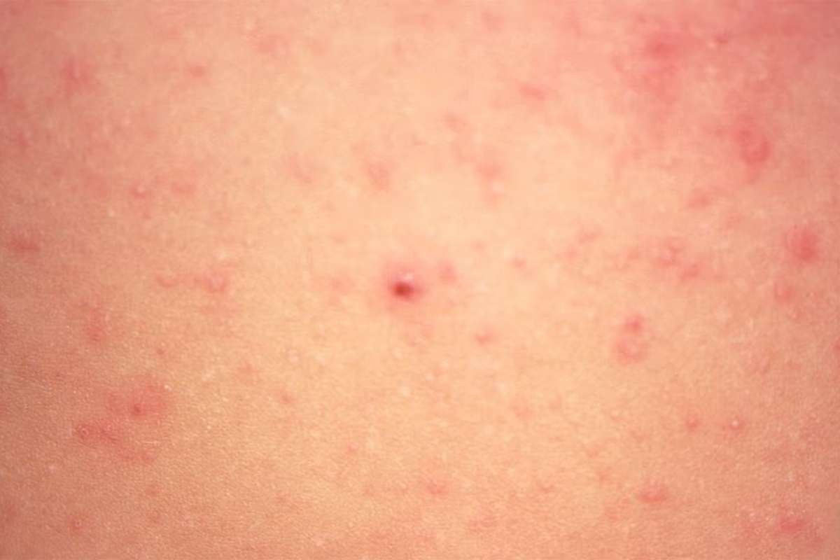 How to Identify Common Bug Bites That Could Harm Your Health? | The Lifesciences Magazine