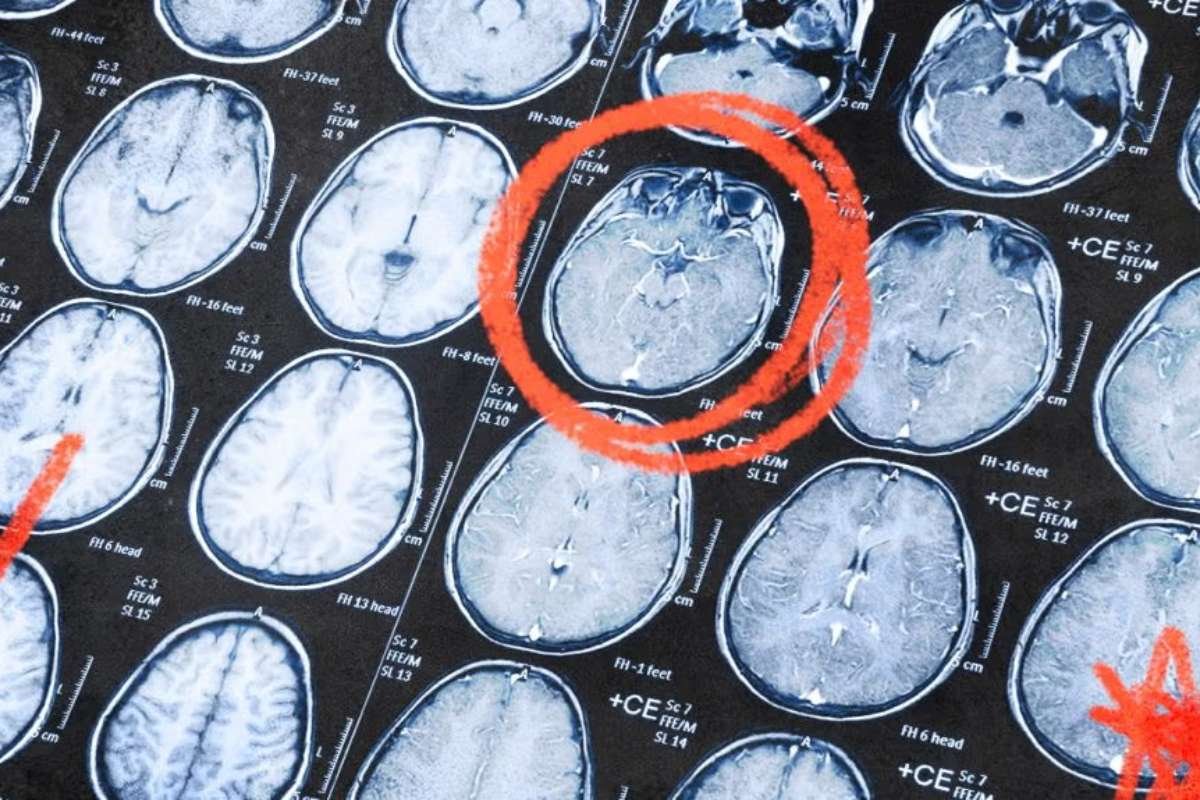 Source - www.medicalnewstoday.com