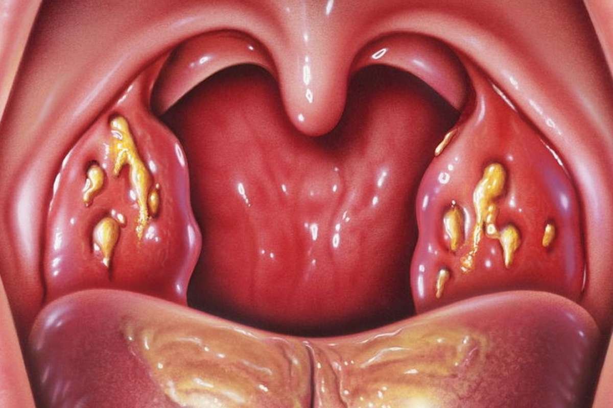 White Spots on Tonsils: Causes & When to See a Doctor | The Lifesciences Magazine