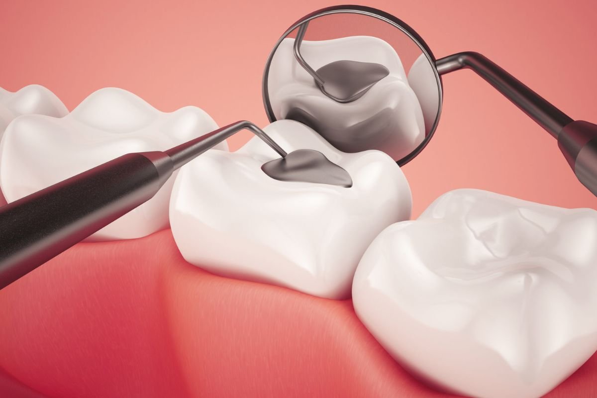 How Much Does a Dental Filling Cost? 2025 Price Shocker | The Lifesciences Magazine