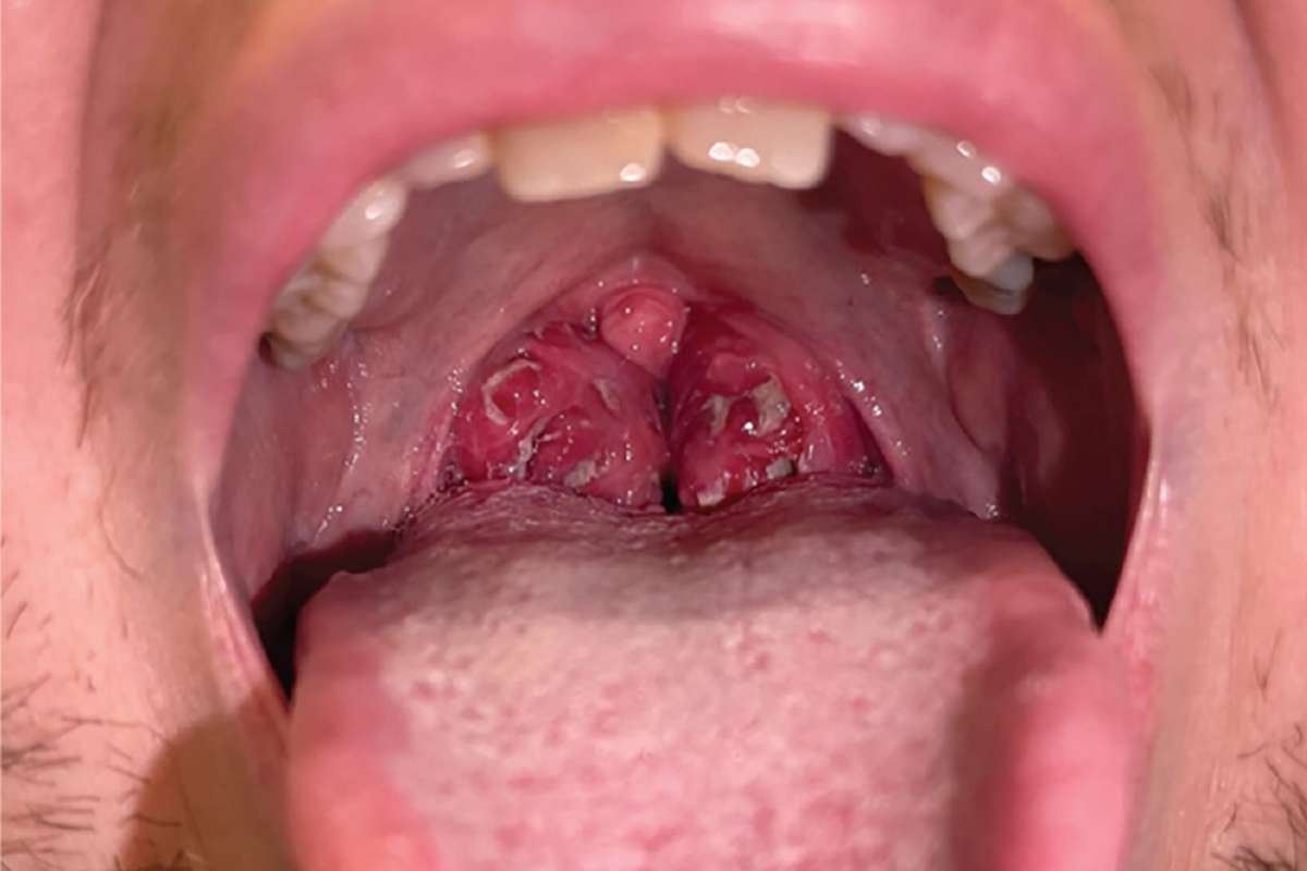 White Spots on Tonsils: Causes & When to See a Doctor | The Lifesciences Magazine