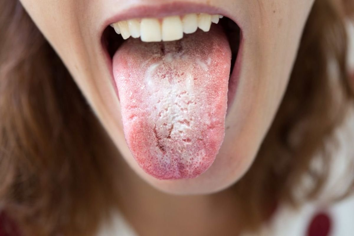 Why White Spots on the Throat May Signal Something Serious | The Lifesciences Magazine