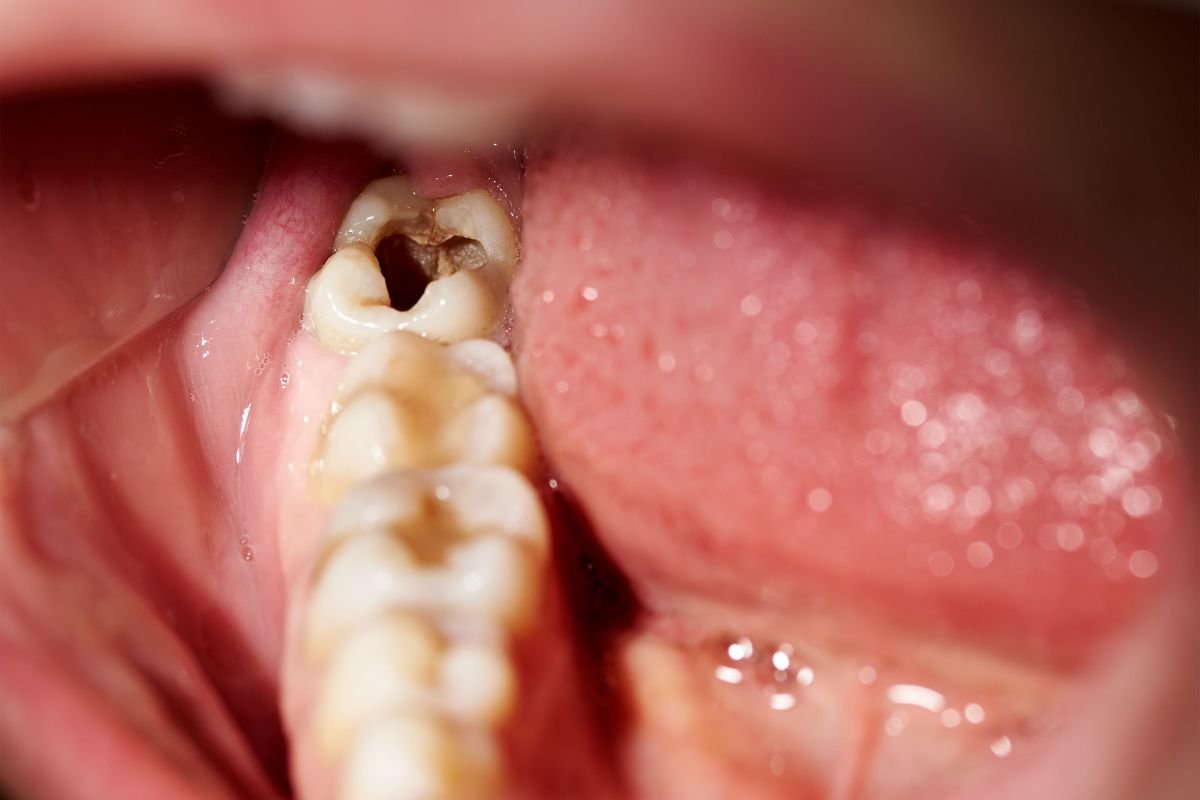 How Much Does a Dental Filling Cost? 2025 Price Shocker | The Lifesciences Magazine